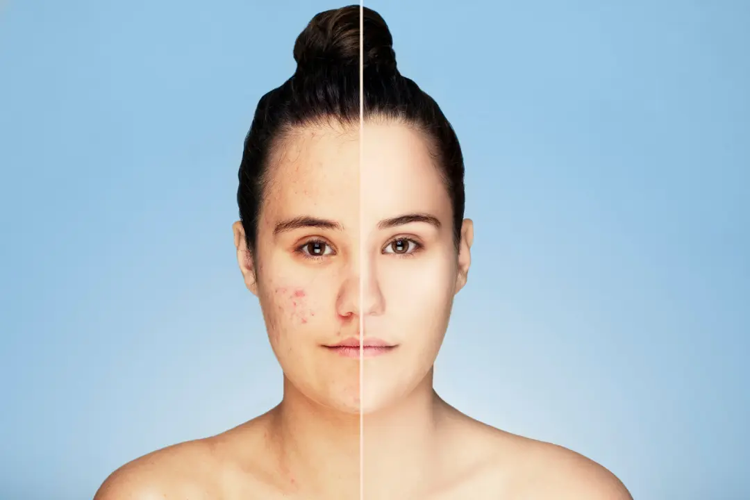 Before and after of acne marks.