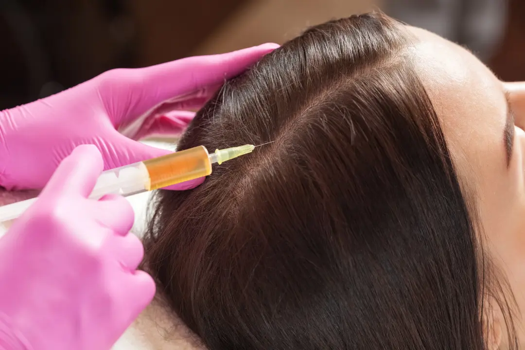 PRP therapy on scalp.